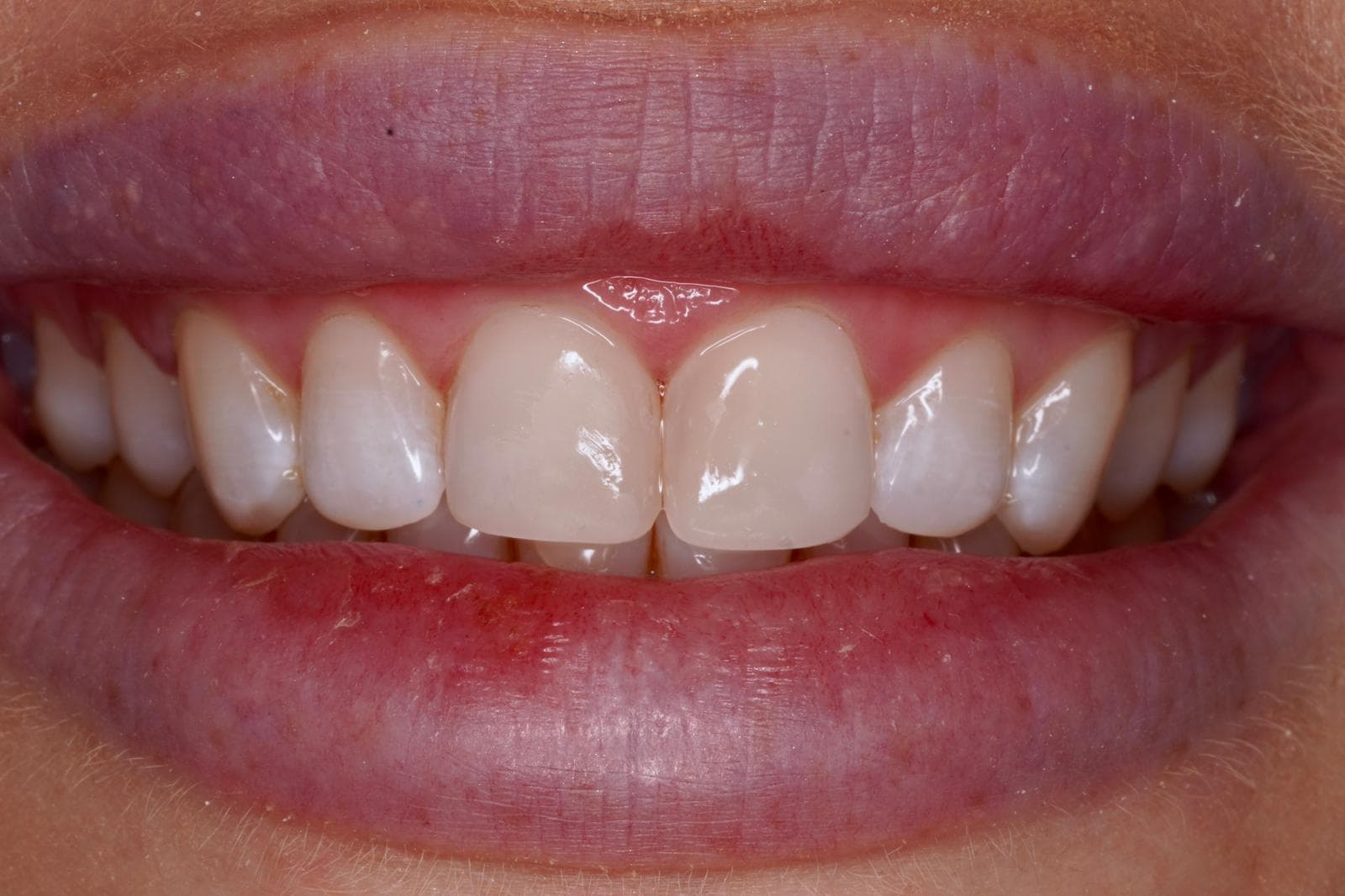 Emergency chipped tooth repair with composite bonding