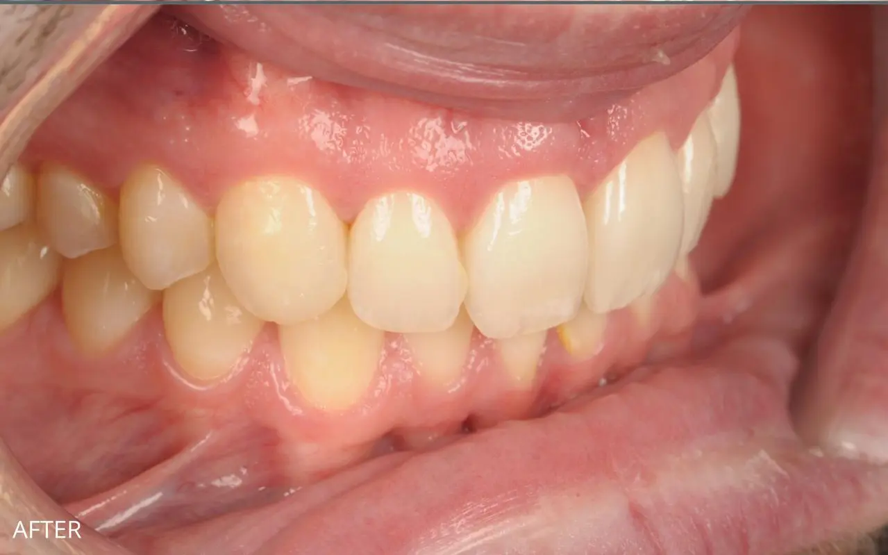 Complete smile makeover with ProAligners clear aligners, composite bonding and teeth whitening