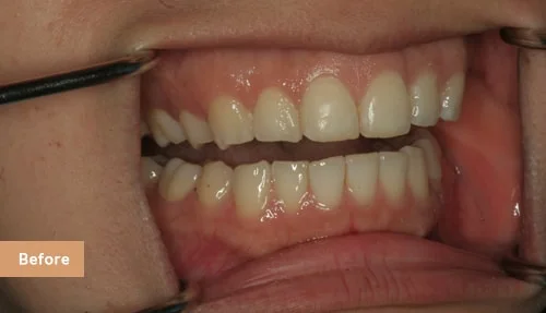 Invisalign and Bonding before 3