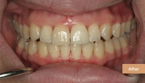 Invisalign and Contouring after 1