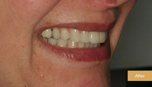 Invisalign and Bonding after 1